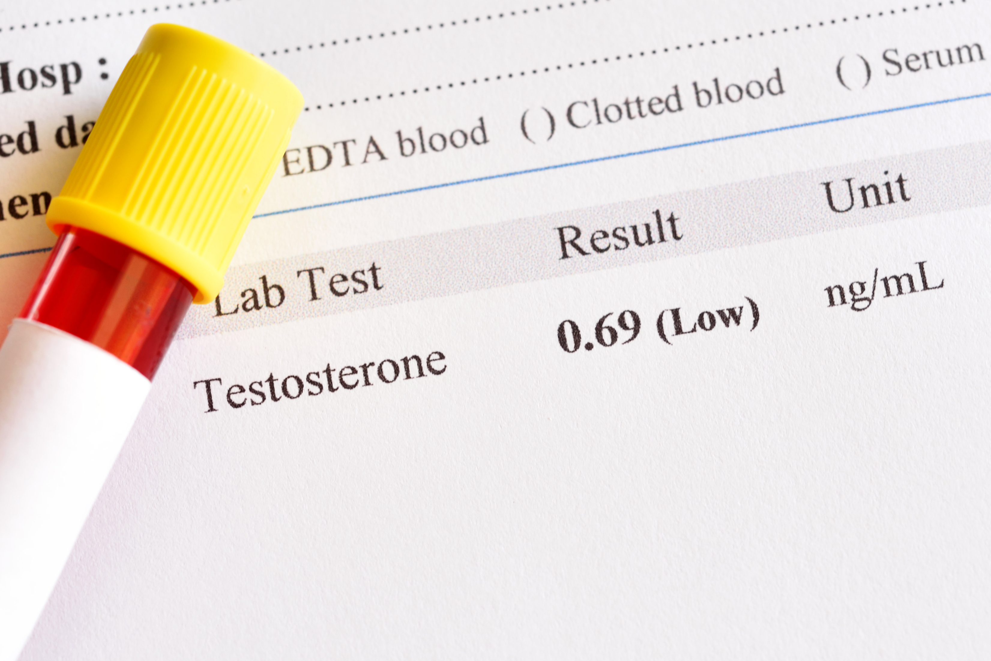 Abnormal low testosterone hormone test result with blood sample tube